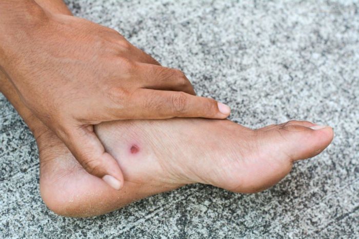 Komplikationen bei Diabetes Fußgeschwüren
