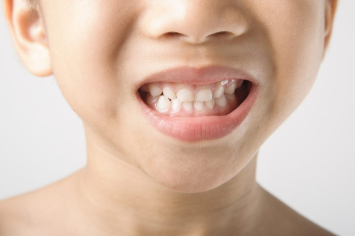 Flecken auf den Zähnen von Kindern