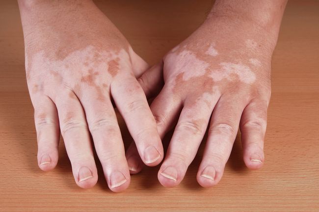 Vitiligo kann heilen