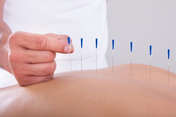 Akupunktur lindert Schmerzen