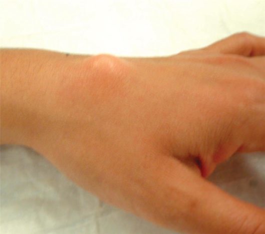 Ganglienzyste am oberen Handgelenk (Quelle: American Society for Surgery of the Hand)