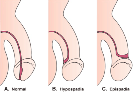 das Penisloch ist nicht normal, Episoden von Hypospadien