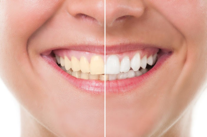 Nebenwirkungen der Zahnaufhellung mit Bleichen