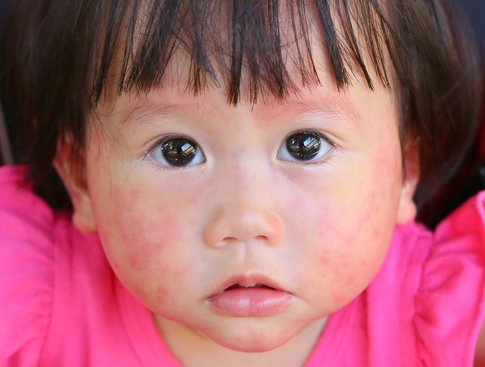 Eigenschaften von Babys, die gegen Kuhmilch allergisch sind