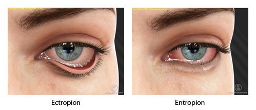 Ektropium von Augenlidabnormalitäten