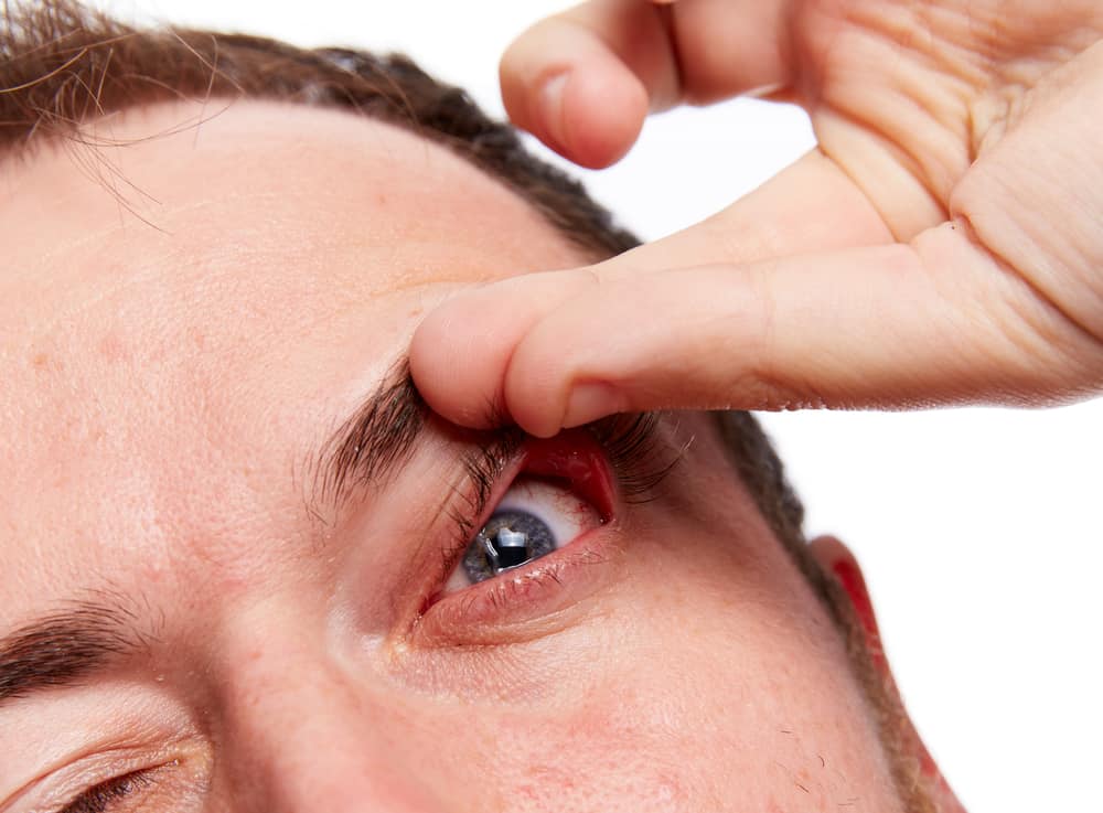 schlaffe Augenlider hängendes Augenlid-Syndrom