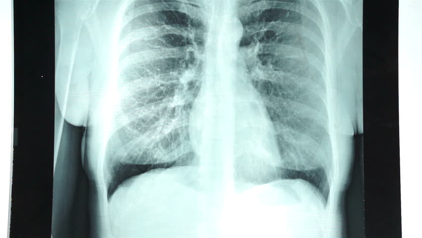 Röntgenaufnahme der Brust