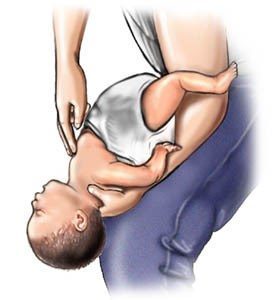 Schritte zur Hilfe beim Ersticken von Babys (4-5) Quelle: www.webmd.com