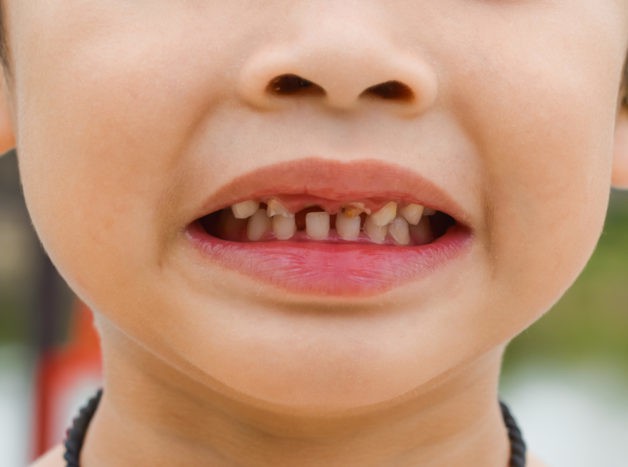 Schäden an den Zähnen von Kindern