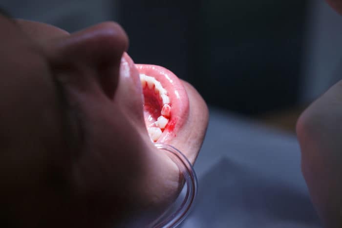 Ursache für Zahnfleischbluten