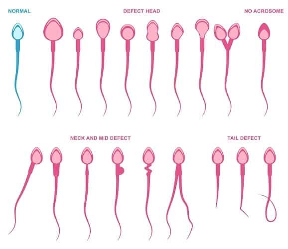 Sperma-Abnormalitäten